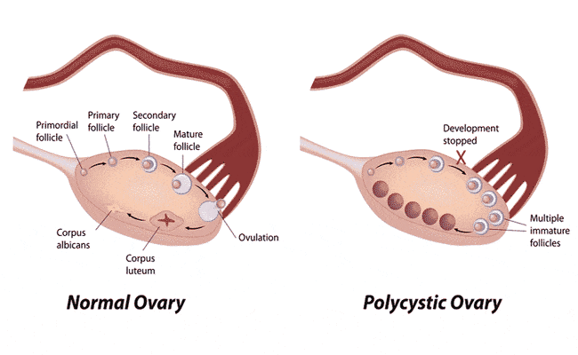 align-thougths-pcosss-ovaries