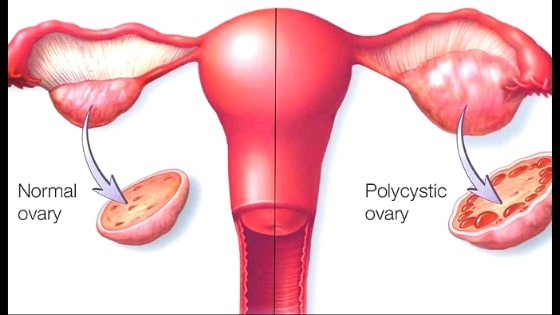 symptoms of pcos in female